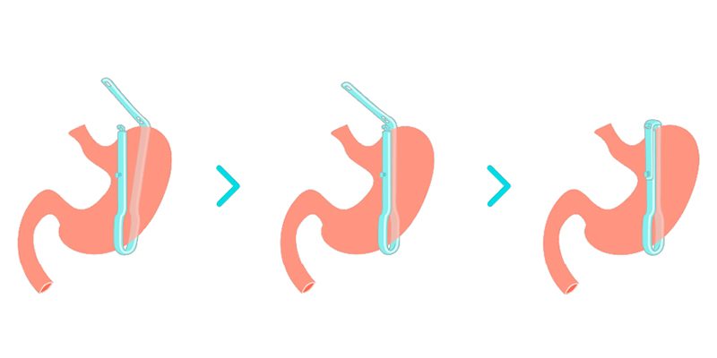 bariclip
