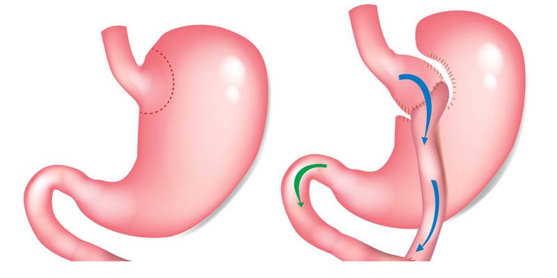 bypass-gastrico